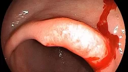 Ранний рак желудка