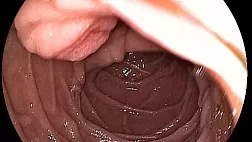 Аденома БДС