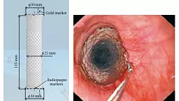 Рекомендации по лечению кровотечений ВРВП 2013