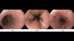Эозинофильный эзофагит: современный взгляд на проблему и собственные клинические наблюдения