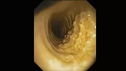 Хондроостеопластическая трахеобронхопатия