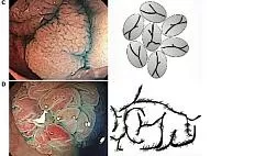 Обзор. Стратегии клинического наблюдения после эндоскопического лечения зубчатых аденом толстой и прямой кишки