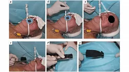 Эндоскопическая вакуумная терапия в лечении несостоятельности анастомозов верхних отделов пищеварительного тракта. Первый опыт и обзор литературы