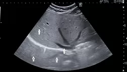 Что такое ультразвук?