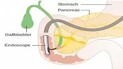 РОЛЬ ВНУТРИПРОСВЕТНЫХ ЭНДОСКОПИЧЕСКИХ ВМЕШАТЕЛЬСТВ В КОМПЛЕКСНОМ ЛЕЧЕНИИ ХРОНИЧЕСКОГО ПАНКРЕАТИТА И ЕГО ОСЛОЖНЕНИЙ автореферат