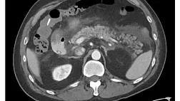 ОСТРЫЙ ПАНКРЕАТИТ КАК ОСЛОЖНЕНИЕ ПОСЛЕ КОЛОНОСКОПИИ