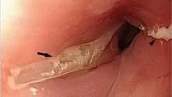 ИНОРОДНЫЕ ТЕЛА ПИЩЕВОДА