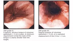 Z-линия пищевода. Классификация зубчатой линии ZAP.  Endoscopic assessment of the “Z-line” (squamocolumnar junction) appearance: reproducibility of the ZAP classification among endoscopists