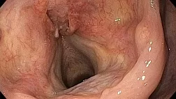 Плоскоклеточная неороговевающая карцинома гортани