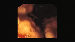 Лимфомa желудка