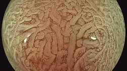 Пример оформления. ЭндоАтлас. Колоноскопия. Аденома. Bli