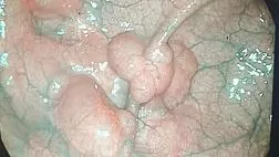 Пневматоз Толстой кишки