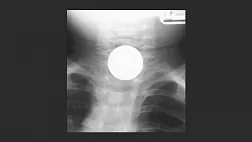 Инородные тела верхнего отдела ЖКТ