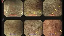 Перевод статьи. Эндоскопическая диагностика раннего рака желудка Kenshi Yao 2013