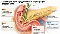 Классификация перфораций двенадцатиперстной кишки, связанных с выполнением эндоскопических транспапиллярных вмешательств по Стапфер (Stapfer M), 2000