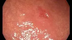 Перстневидноклеточный рак желудка.