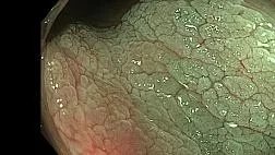 Sessile Serrated Lesion (SSL) - осмотр в NBI + хромоскопия уксусной кислотой
