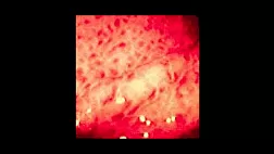 Гастропатия при портальной гипертензии. Классификация тяжести портальной гипертензивной гастропатии по McCormack T.T.