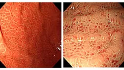 ПОРТАЛЬНАЯ ГИПЕРТЕНЗИВНАЯ ГАСТРОПАТИЯ. ПГГ. ОБЗОР ЛИТЕРАТУРЫ