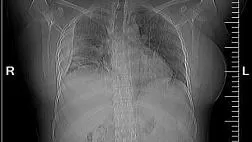 Применение эндоскопической клапанной бронхоблокации у пациентки 34 лет. Закон парных случаев в дейст