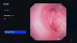 Успешно апробировано окклюзия бронхоплеврального свища