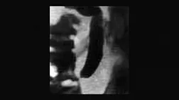 Дисфункция сфинктера Одди