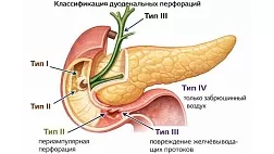 Классификация перфораций двенадцатиперстной кишки, связанных с выполнением эндоскопических транспапиллярных вмешательств по Стапфер (Stapfer M), 2000