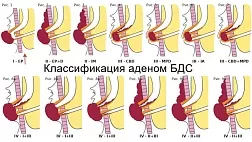 Эндоскопическая классификация новообразований большого сосочка двенадцатиперстной кишки БСДК (Старков Ю. Г. и соавторы, 2024 г.) 