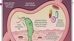 Методы диагностики инфекции Хеликобактер пилори (Helicobacter pylori) в клинический практике