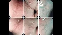 Узкоспекртральная эндоскопия NBI признаки при эозинофильном и лимфоцитарном эзофагите