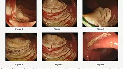 Colonic Mucosal Pseudolipomatosis: Diagnosis and Etiology