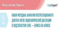 НОВАЯ МЕТОДИКА ЗАКРЫТИЯ ПОСТРЕЗЕКЦИОННОГО ДЕФЕКТА ПОСЛЕ ЭНДОСКОПИЧЕСКОЙ ДИССЕКЦИИ В ПОДСЛИЗИСТОМ СЛОЕ — КЛИПСА НА КЛИПСЕ