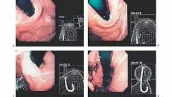 Классификация Hill - Эндоскопическая оценка состояния гастроэзофагеального створчатого клапана (ГЭСК) Губарева (Gastroesophageal flap valve — GEFV) по Hill L.D.