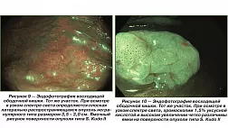 Латерально распространяющиеся опухоли толстой кишки при колоноскопии с высокой разрешающей способностью, исследованием в узком спектре света и хромоскопией уксусной кислотой