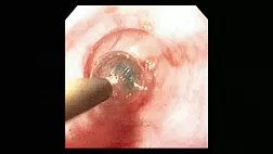 Баллонная дилатация стриктур ЖКТ