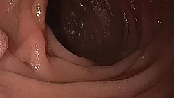 Дуоденальная лимфангиэктазия: эндоскопическая находка и её клиническая интерпретация. Классификация по Kim J.H.