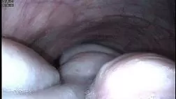 Фиброваскулярный полип пищевода. 