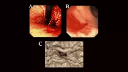 Повреждение Делафуа