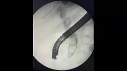 Ретроградная холангиопанкреатография при юкстадивертикулярном расположении большого дуоденального сосочка.