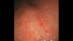 Симптом перетяжек по типу "бамбука" - патогномоничный признак болезни Крона желудка