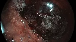 Метастаз меланомы в желудок