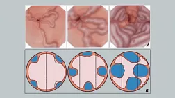 РОЛЬ ЛИГИРОВАНИЯ ВАРИКОЗНО-РАСШИРЕННЫХ ВЕН ПИЩЕВОДА В ПРОФИЛАКТИКЕ КРОВОТЕЧЕНИЙ ПОРТАЛЬНОГО ГЕНЕЗА