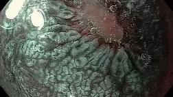 Эндоскопические признаки кишечной метаплазии