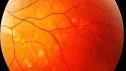 Семейный аденоматозный полипоз: симптомы, генетика