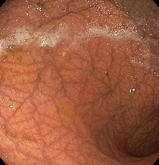 Атрофия слизистой желудка на фоне хронического гастрита. Атлас эндоскопических изображений endoatlas
