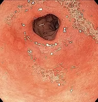 Ранний рак желудка. Атлас эндоскопических изображений endoatlas