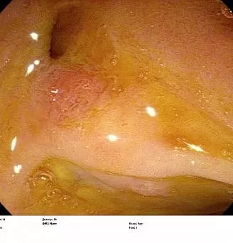 Супрапапиллярный свищ. Атлас эндоскопических изображений endoatlas