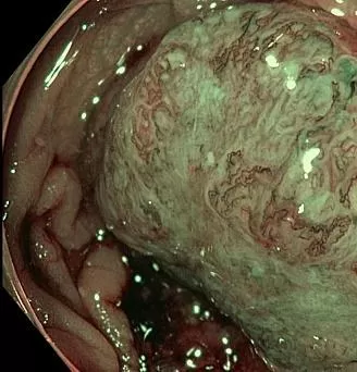 Инвазивная аденокарцинома сигмовидной кишки.. Атлас эндоскопических изображений endoatlas