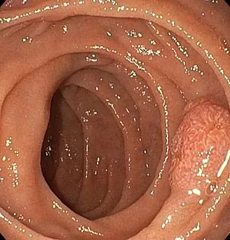 Меланома. Метастаз в ДПК.. Атлас эндоскопических изображений endoatlas