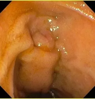 Вид БДС при дуоденоскопии после резекции желудка по_Бильрот-2. Атлас эндоскопических изображений endoatlas